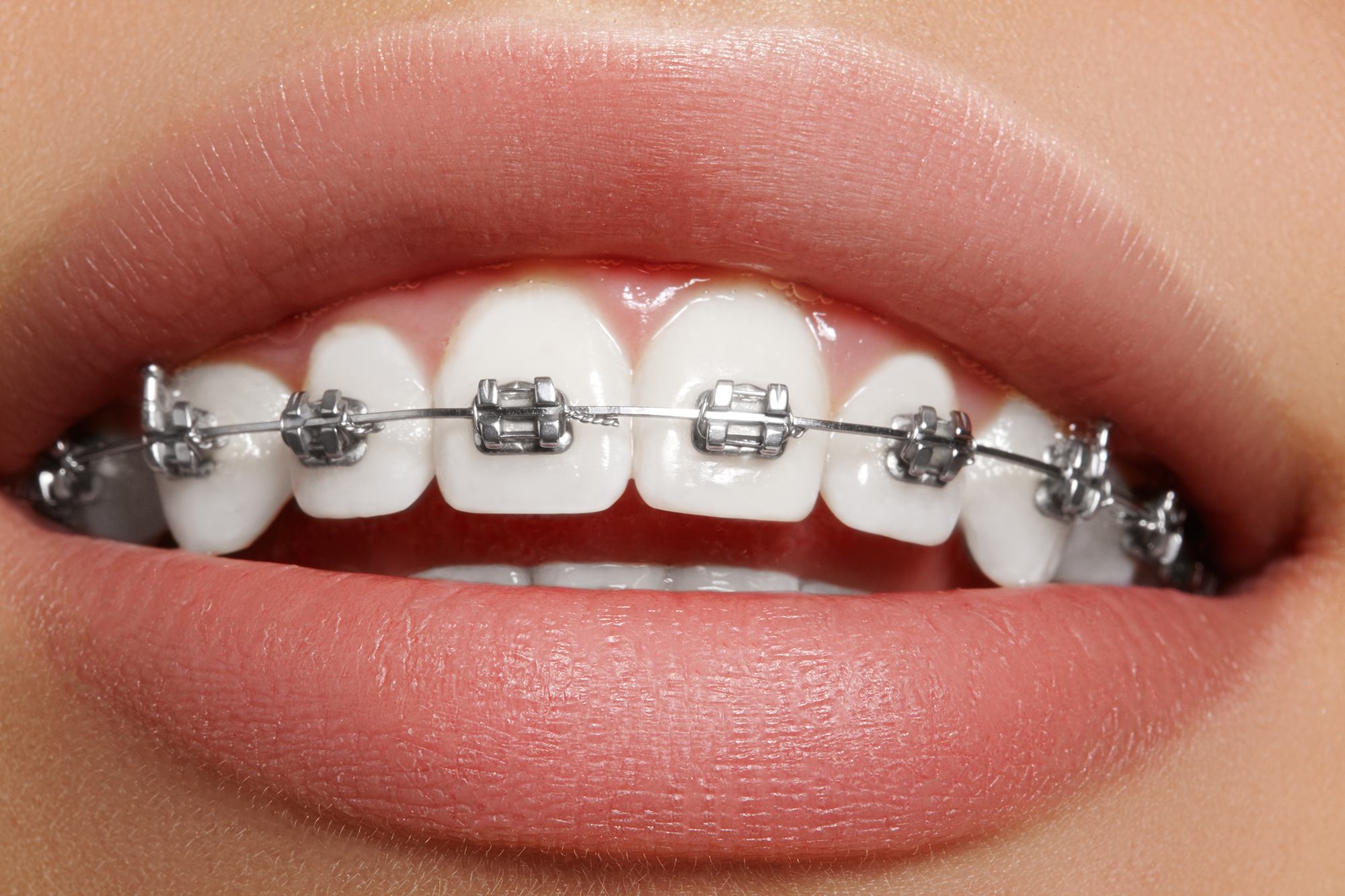 braces beacon dental group dentist in dorchester ma