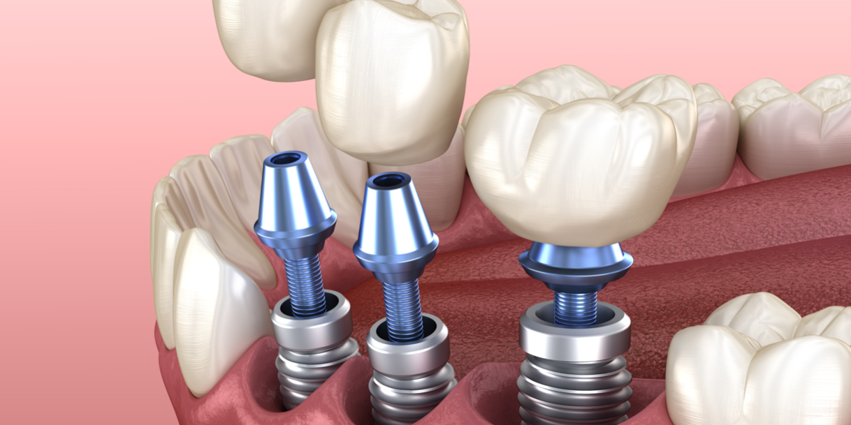 Why Choose Dental Implants? Beacon Dental Group Dentist in MA 02124