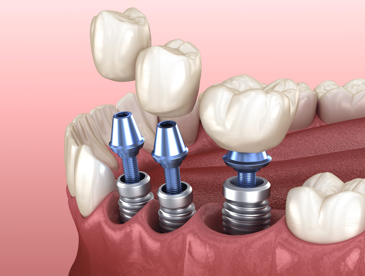 Why choose dental implants - dental implants illustration - Beacon Dental Group dentist in Dorchester MA Cressida Joseph DMD, Cuthbert Joseph RDH, Dr. Jacqueline Jacobson, Dr. Danika Crabtree, Serving Dorchester MA Hyde Park MA, Quincy MA, Milton MA, Chelsea MA, Watertown MA